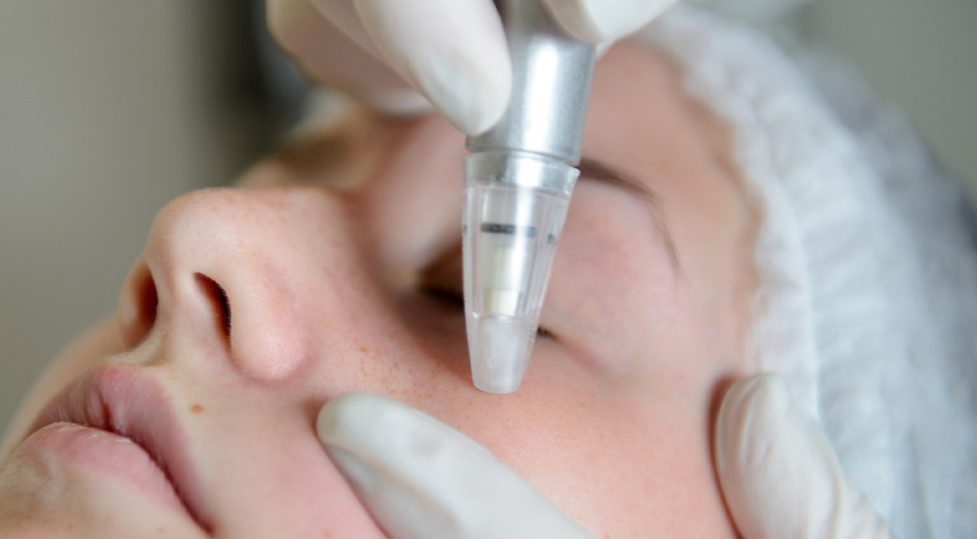 What Is Microdermabrasion?